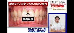 livegalileo 1746938971 1001 300x135 - 【衝撃】 歯科医師「フロスや歯間ブラシは絶対に使うな！」