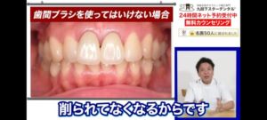 livegalileo 1746938971 1002 300x135 - 【衝撃】 歯科医師「フロスや歯間ブラシは絶対に使うな！」